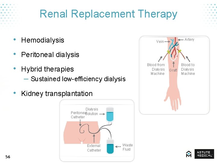 Renal Replacement Therapy • Hemodialysis Artery Vein • Peritoneal dialysis • Hybrid therapies –