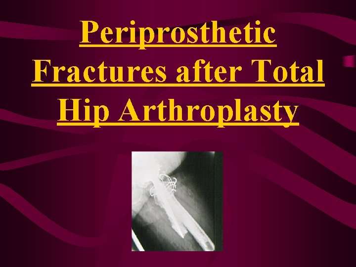 Periprosthetic Fractures after Total Hip Arthroplasty Periprosthetic Fractures after Total Hip Arthroplasty