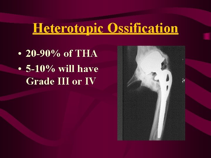 Heterotopic Ossification • 20 -90% of THA • 5 -10% will have Grade III Heterotopic Ossification • 20 -90% of THA • 5 -10% will have Grade III