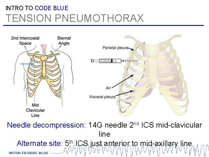 INTRO TO CODE BLUE TENSION PNEUMOTHORAX Needle decompression: 14 G needle 2 nd ICS INTRO TO CODE BLUE TENSION PNEUMOTHORAX Needle decompression: 14 G needle 2 nd ICS