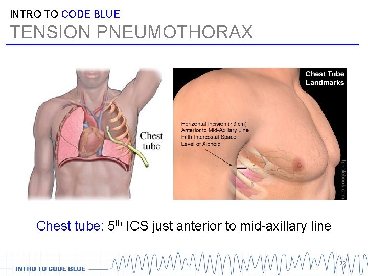INTRO TO CODE BLUE TENSION PNEUMOTHORAX Chest tube: 5 th ICS just anterior to INTRO TO CODE BLUE TENSION PNEUMOTHORAX Chest tube: 5 th ICS just anterior to