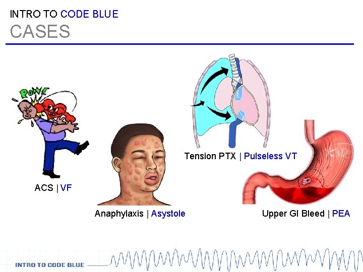 INTRO TO CODE BLUE CASES Tension PTX | Pulseless VT ACS | VF Anaphylaxis INTRO TO CODE BLUE CASES Tension PTX | Pulseless VT ACS | VF Anaphylaxis
