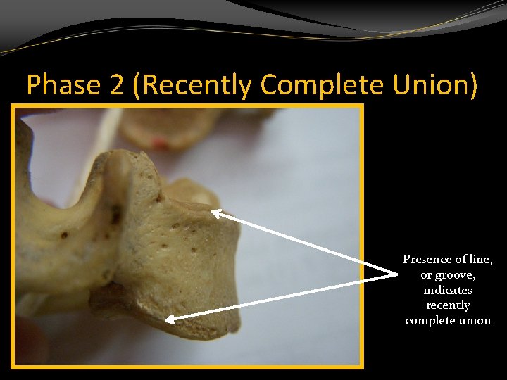 Phase 2 (Recently Complete Union) Presence of line, or groove, indicates recently complete union