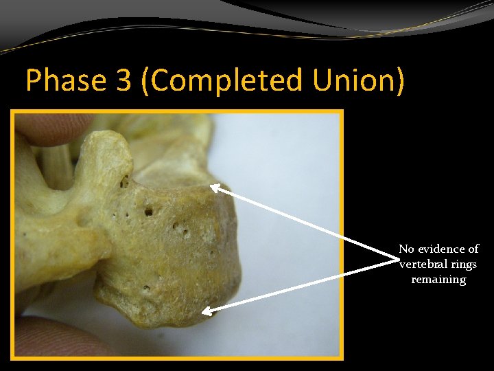 Phase 3 (Completed Union) No evidence of vertebral rings remaining 