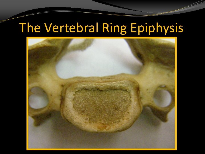 The Vertebral Ring Epiphysis 