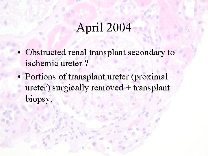 April 2004 • Obstructed renal transplant secondary to ischemic ureter ? • Portions of