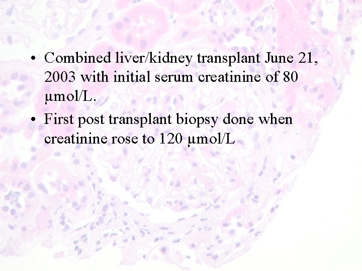  • Combined liver/kidney transplant June 21, 2003 with initial serum creatinine of 80