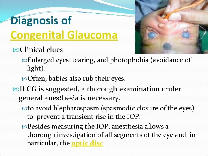 Diagnosis of Congenital Glaucoma Clinical clues Enlarged eyes; tearing, and photophobia (avoidance of light).