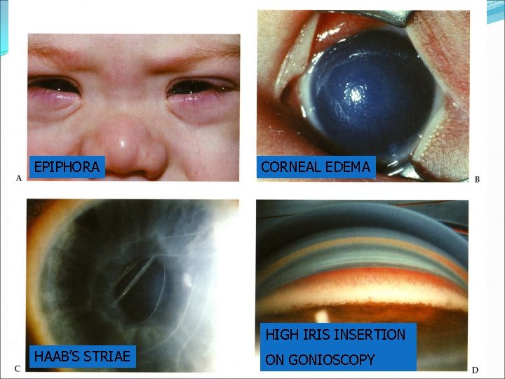 EPIPHORA CORNEAL EDEMA HIGH IRIS INSERTION HAAB’S STRIAE ON GONIOSCOPY 