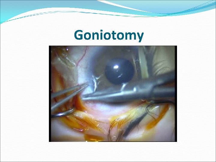 Goniotomy 