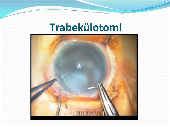 Trabekülotomi 