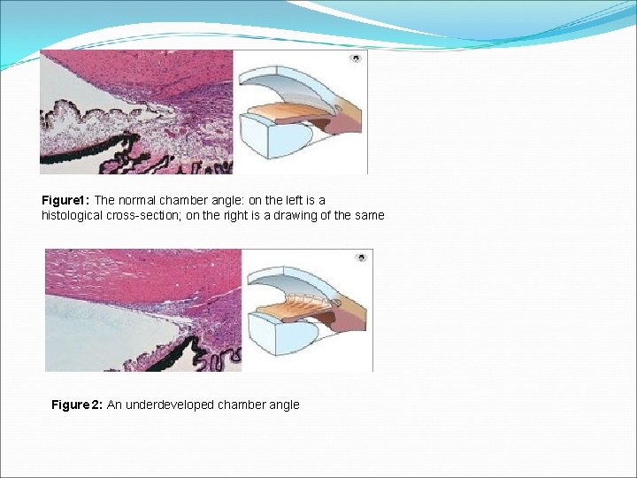 Figure 1: The normal chamber angle: on the left is a histological cross-section; on