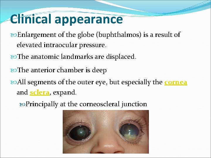 Clinical appearance Enlargement of the globe (buphthalmos) is a result of elevated intraocular pressure.