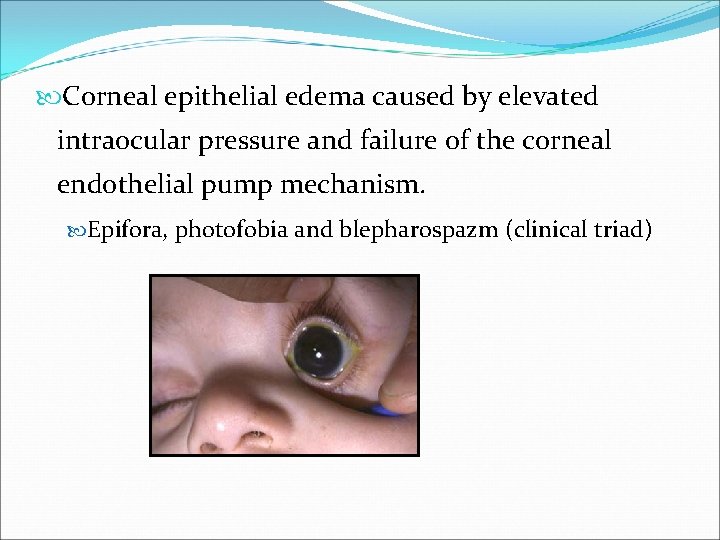  Corneal epithelial edema caused by elevated intraocular pressure and failure of the corneal