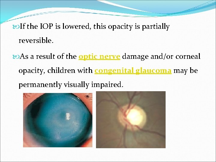  If the IOP is lowered, this opacity is partially reversible. As a result