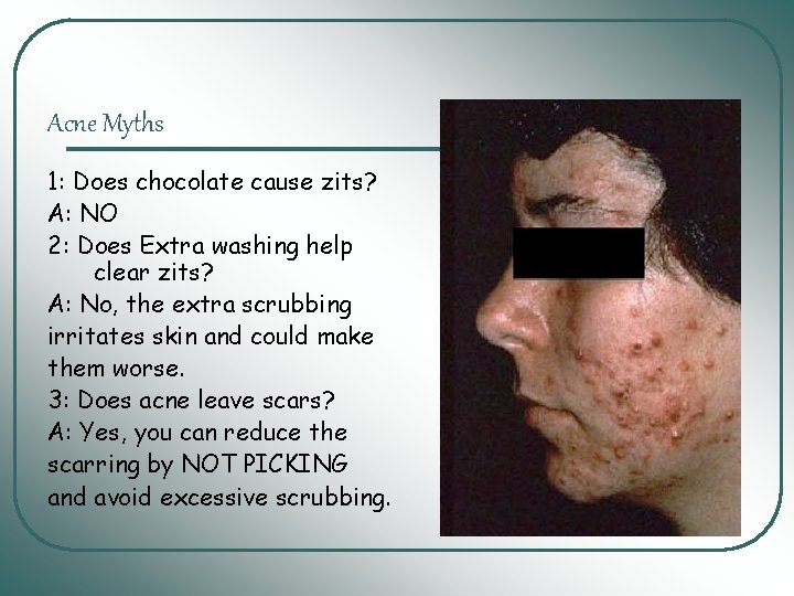 Acne Myths 1: Does chocolate cause zits? A: NO 2: Does Extra washing help Acne Myths 1: Does chocolate cause zits? A: NO 2: Does Extra washing help