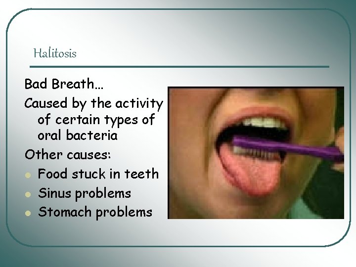 Halitosis Bad Breath… Caused by the activity of certain types of oral bacteria Other Halitosis Bad Breath… Caused by the activity of certain types of oral bacteria Other