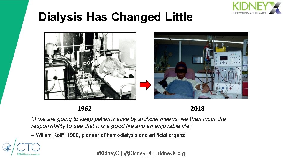 Dialysis Has Changed Little 1962 2018 “If we are going to keep patients alive Dialysis Has Changed Little 1962 2018 “If we are going to keep patients alive