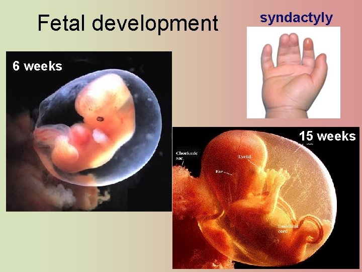 Fetal development syndactyly 6 weeks 15 weeks 