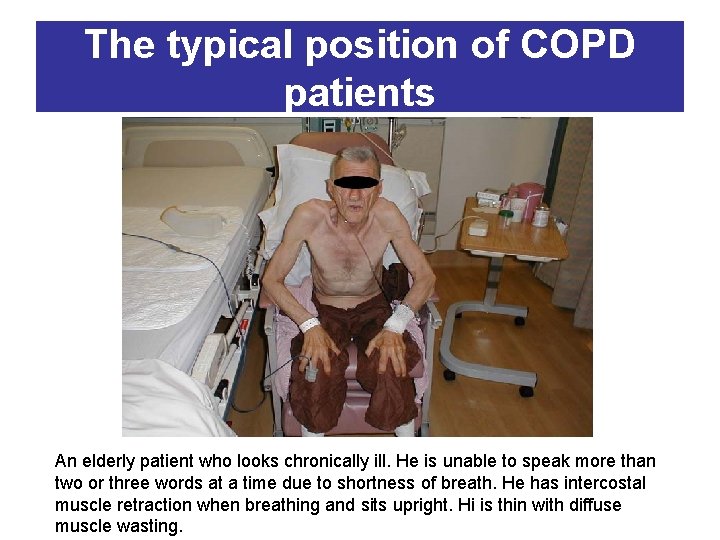 The typical position of COPD patients An elderly patient who looks chronically ill. He