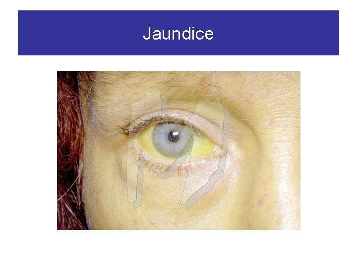 Jaundice 