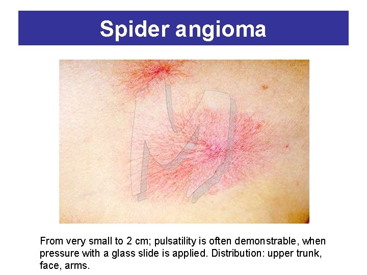 Spider angioma From very small to 2 cm; pulsatility is often demonstrable, when pressure