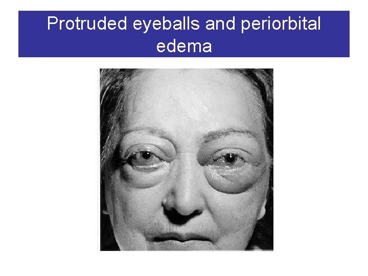 Protruded eyeballs and periorbital edema 