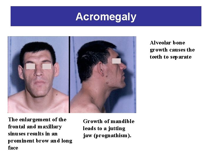 Acromegaly Alveolar bone growth causes the teeth to separate The enlargement of the frontal
