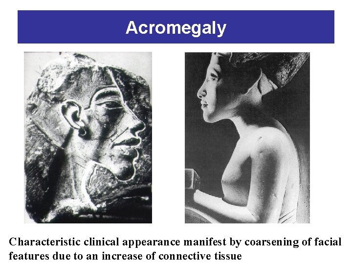 Acromegaly Characteristic clinical appearance manifest by coarsening of facial features due to an increase