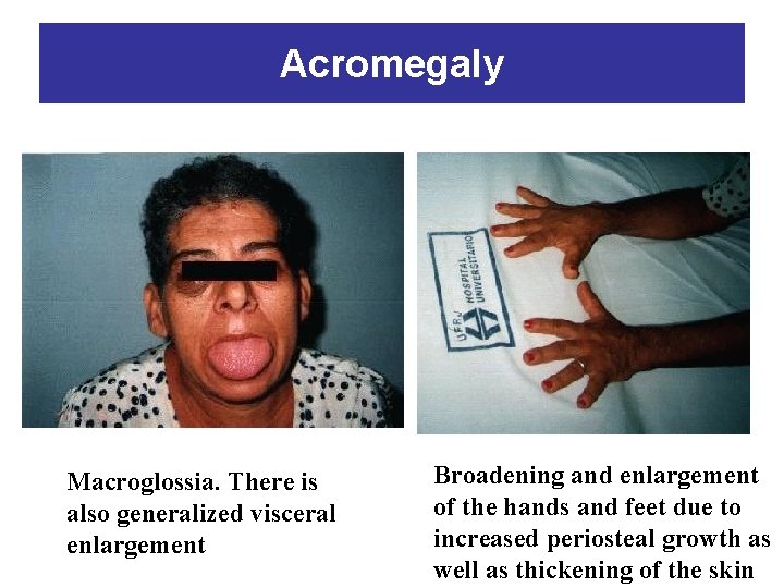 Acromegaly Macroglossia. There is also generalized visceral enlargement Broadening and enlargement of the hands