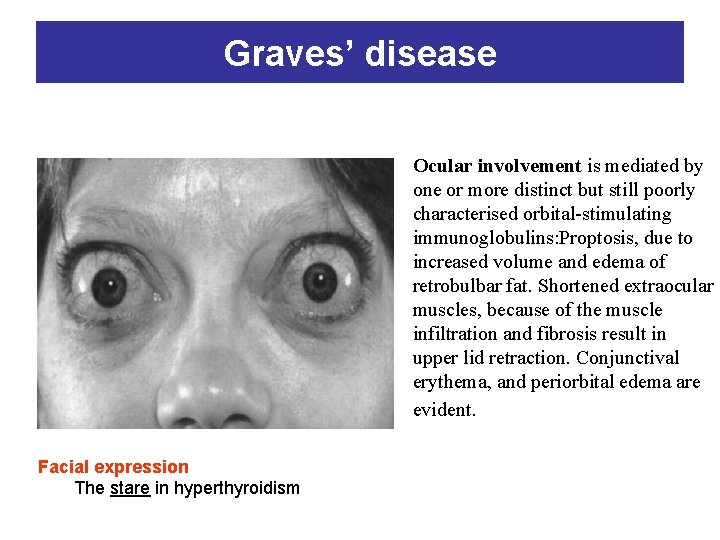 Graves’ disease Ocular involvement is mediated by one or more distinct but still poorly