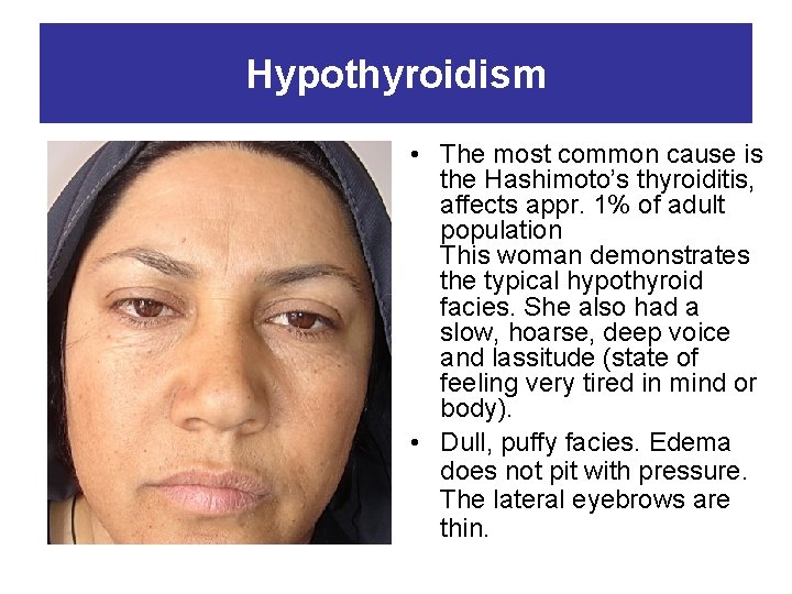 Hypothyroidism • The most common cause is the Hashimoto’s thyroiditis, affects appr. 1% of