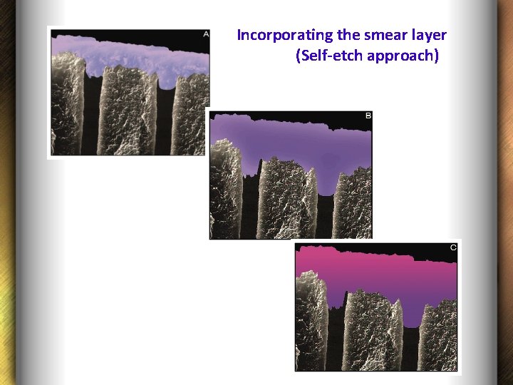 Incorporating the smear layer (Self-etch approach) 