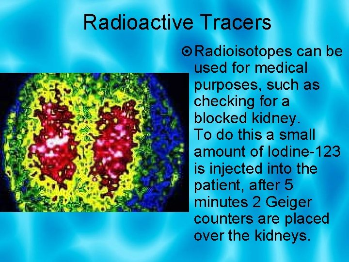 Radioactive Tracers Radioisotopes can be used for medical purposes, such as checking for a