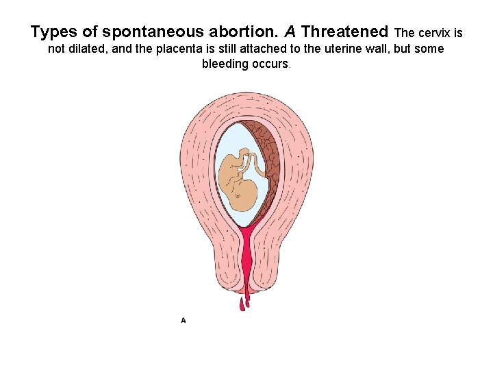 Types of spontaneous abortion. A Threatened The cervix is not dilated, and the placenta