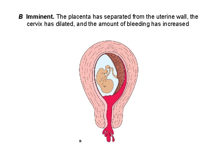 B Imminent. The placenta has separated from the uterine wall, the cervix has dilated,