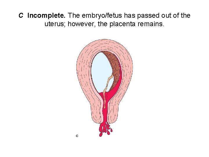 C Incomplete. The embryo/fetus has passed out of the uterus; however, the placenta remains.