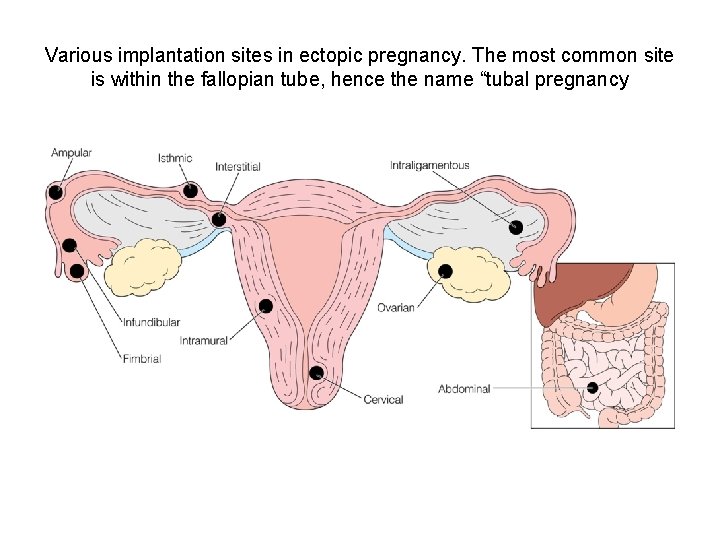 Various implantation sites in ectopic pregnancy. The most common site is within the fallopian