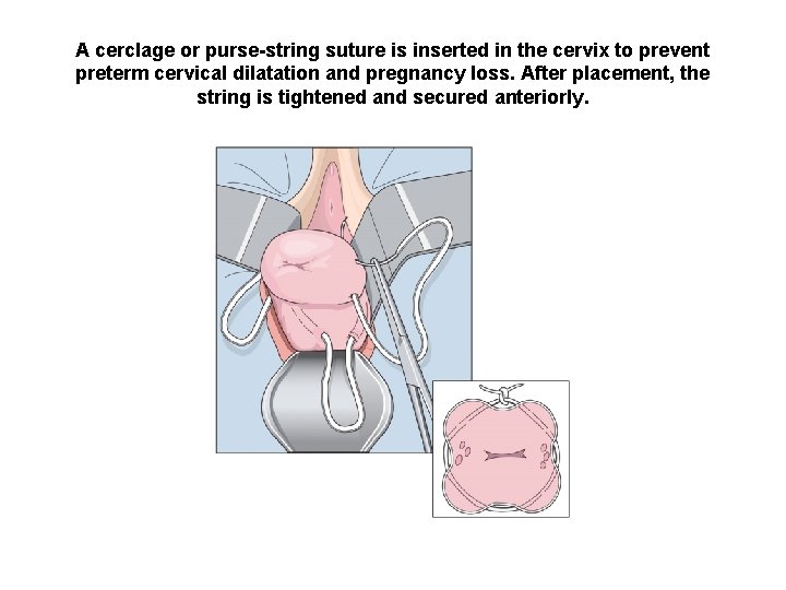 A cerclage or purse-string suture is inserted in the cervix to prevent preterm cervical