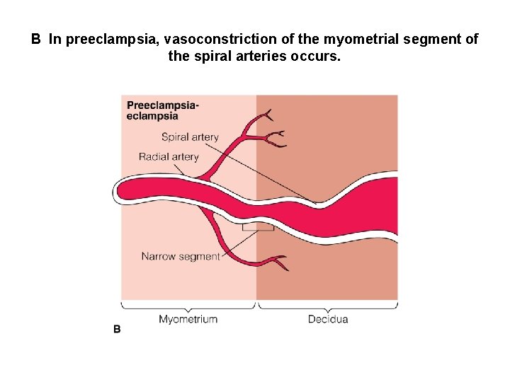 B In preeclampsia, vasoconstriction of the myometrial segment of the spiral arteries occurs. 