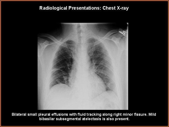 Radiological Presentations: Chest X-ray Bilateral small pleural effusions with fluid tracking along right minor