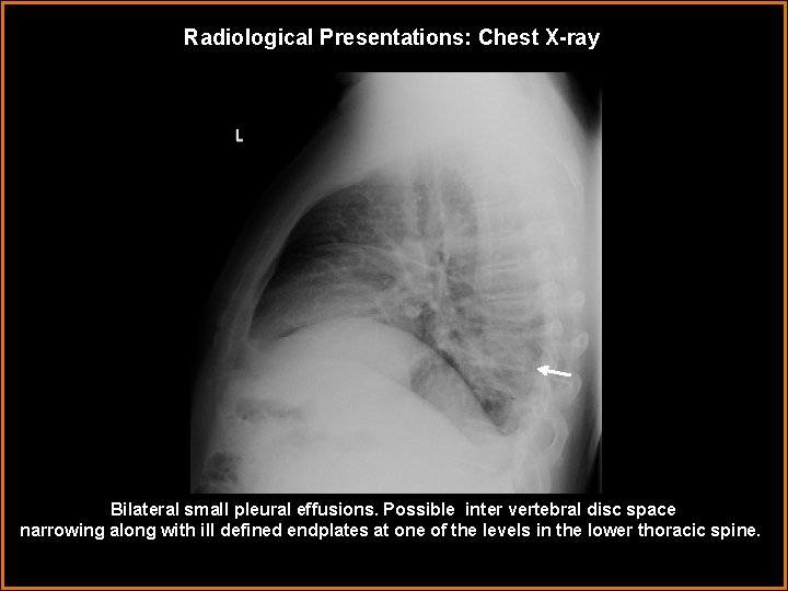 Radiological Presentations: Chest X-ray Bilateral small pleural effusions. Possible inter vertebral disc space narrowing