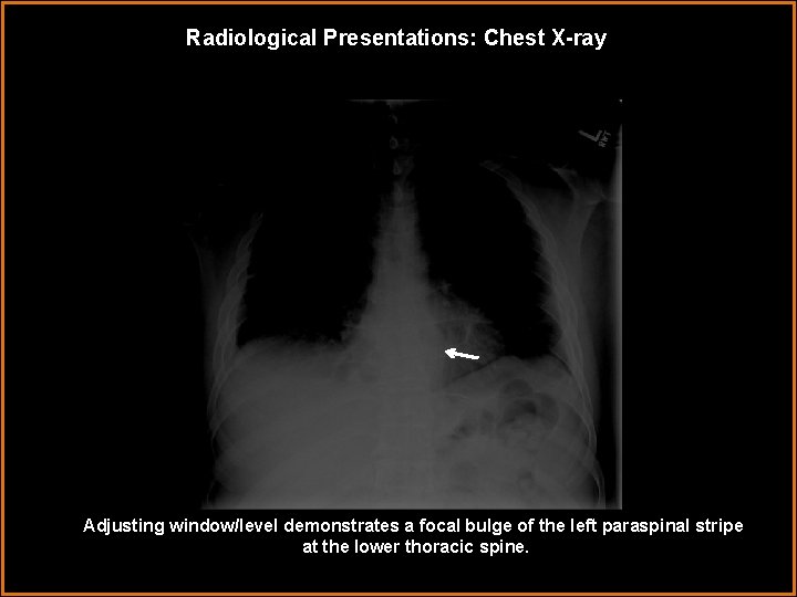 Radiological Presentations: Chest X-ray Adjusting window/level demonstrates a focal bulge of the left paraspinal
