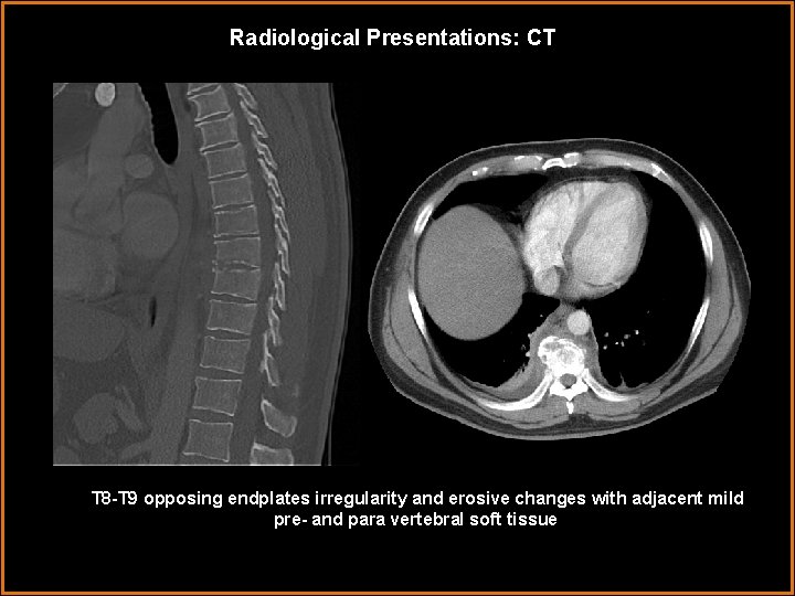 Radiological Presentations: CT T 8 -T 9 opposing endplates irregularity and erosive changes with