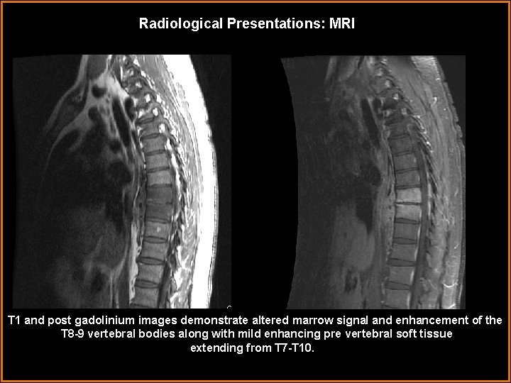 Radiological Presentations: MRI T 1 and post gadolinium images demonstrate altered marrow signal and