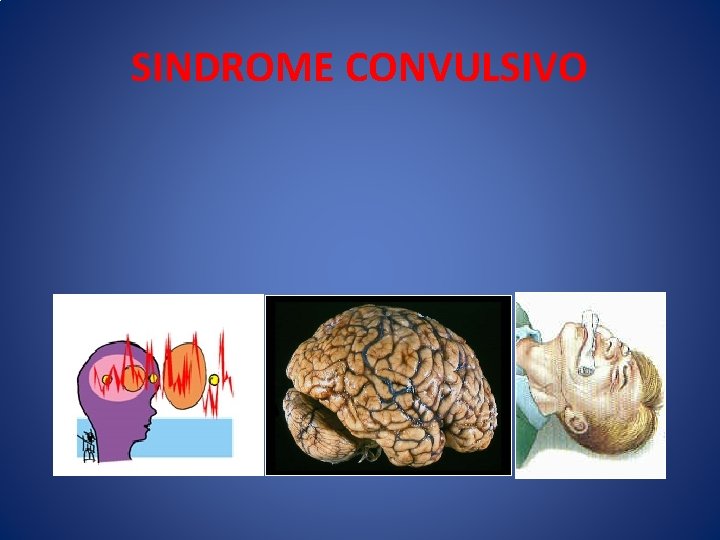 SINDROME CONVULSIVO 