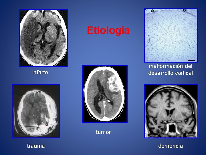 Etiología malformación del desarrollo cortical infarto tumor trauma demencia 