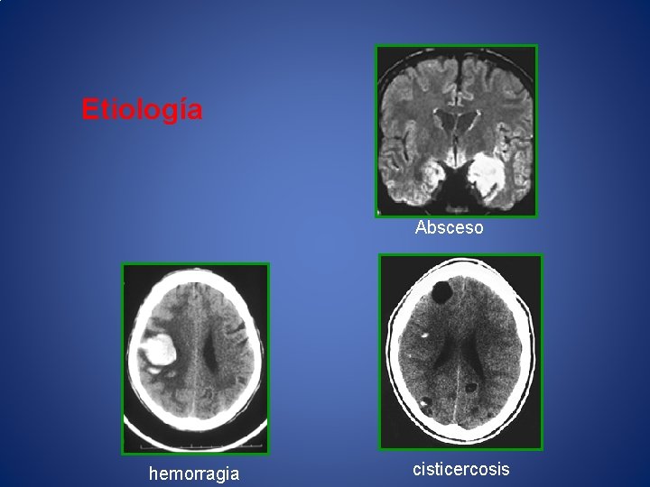 Etiología Absceso hemorragia cisticercosis 