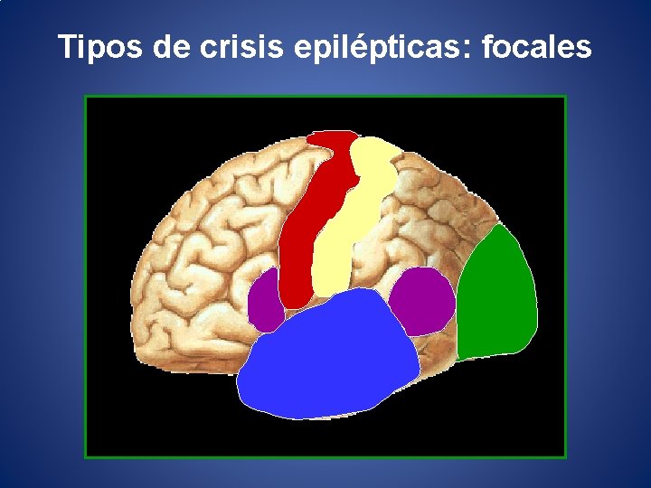 Tipos de crisis epilépticas: focales 