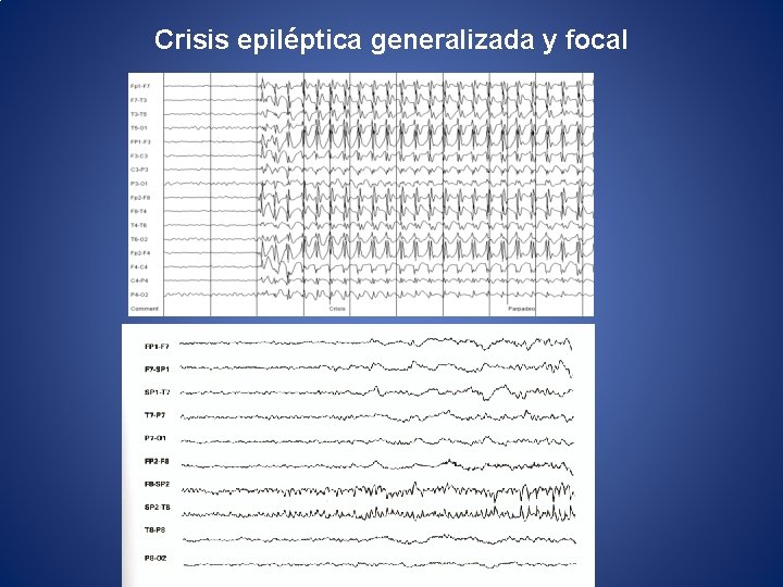 Crisis epiléptica generalizada y focal 